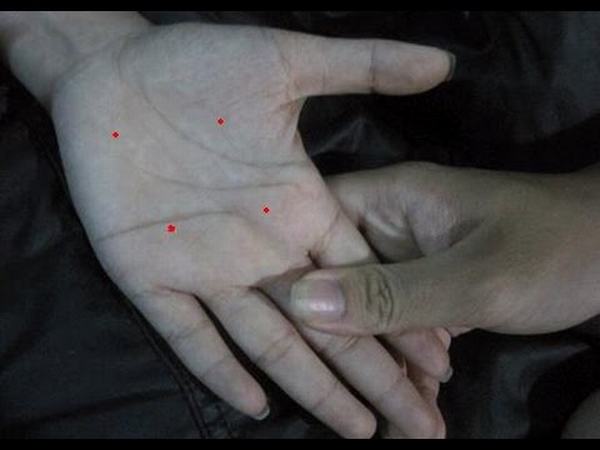 Nốt ruồi trong lòng bàn tay trái