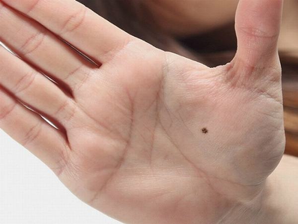 Nốt ruồi ở lòng bàn tay phụ nữ có ý nghĩa gì?